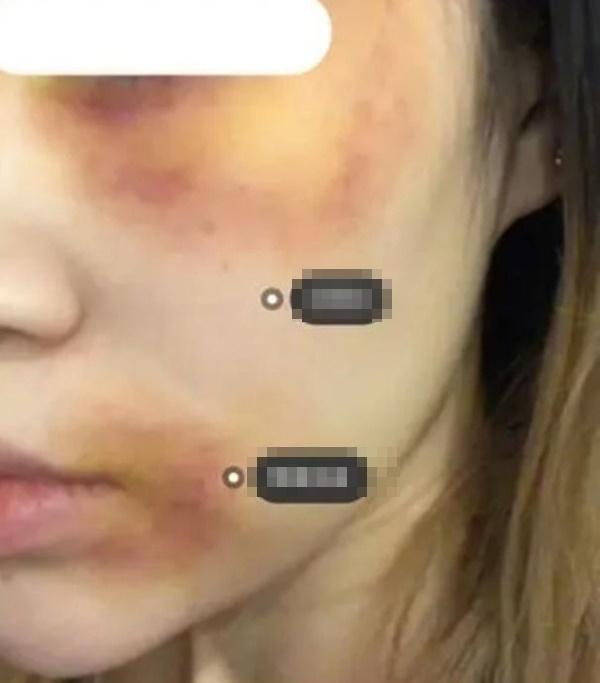 Loạt bạn trẻ xuất hiện với gương mặt bầm tím như bị bạo hành, tất cả do Halloween mà ra-2