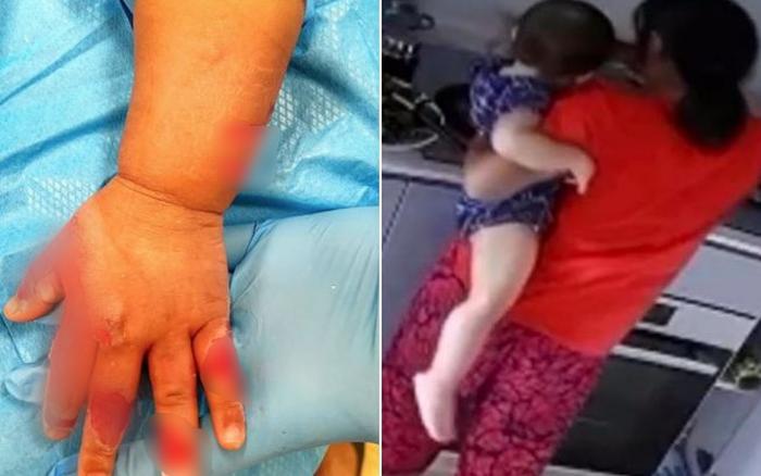 Giúp việc tàn bạo nhúng tay bé 16 tháng vào nồi nước sôi chỉ vì khóc nhiều-1
