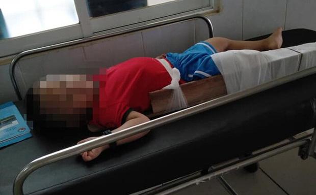 Bé 4 tuổi đi mẫu giáo bị gãy xương đùi: Giáo viên gác chân bé lên cổ-1