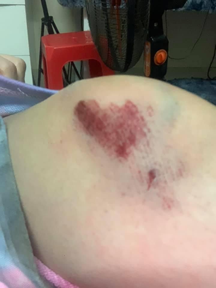 Lời kể của cô gái Sài Gòn bị kẻ cướp điện thoại kéo lê 3 mét trên đường-2