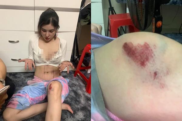 Body bỏng mắt của cô gái trẻ Sài Gòn bị cướp kéo lê 3 mét trên đường-7