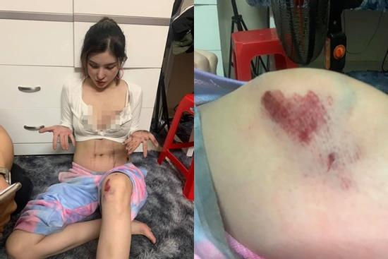 Gái xinh bị cướp kéo lê 3m bức xúc vì nhiều bình luận khiếm nhã: 'Có điên đâu'