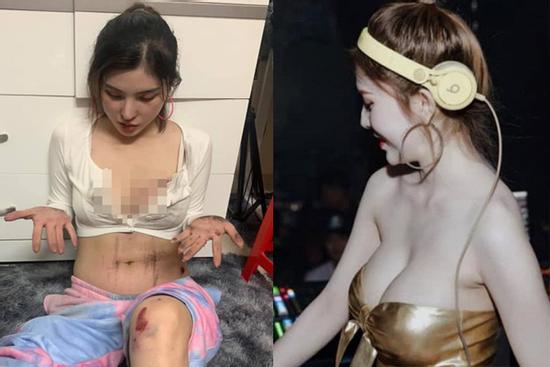 Body bỏng mắt của cô gái trẻ Sài Gòn bị cướp kéo lê 3 mét trên đường