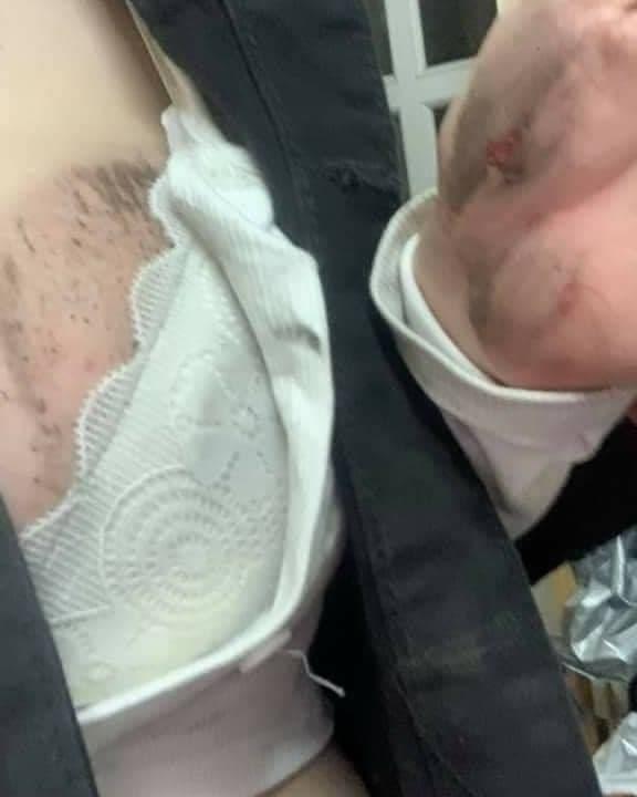 Body bỏng mắt của cô gái trẻ Sài Gòn bị cướp kéo lê 3 mét trên đường-2