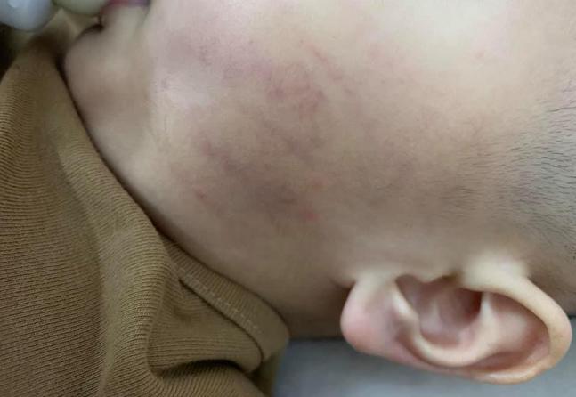 Bé 21 tháng bị cô giáo tát tím mặt, dấu tay in rõ trên má vẫn nói dối bị bạn cào-2