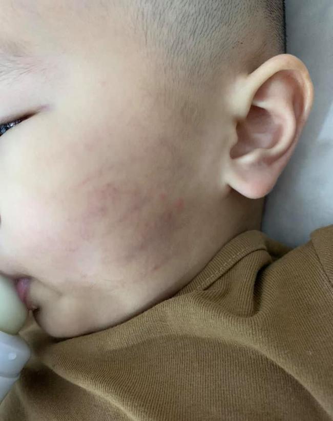 Bé 21 tháng bị cô giáo tát tím mặt, dấu tay in rõ trên má vẫn nói dối bị bạn cào-3