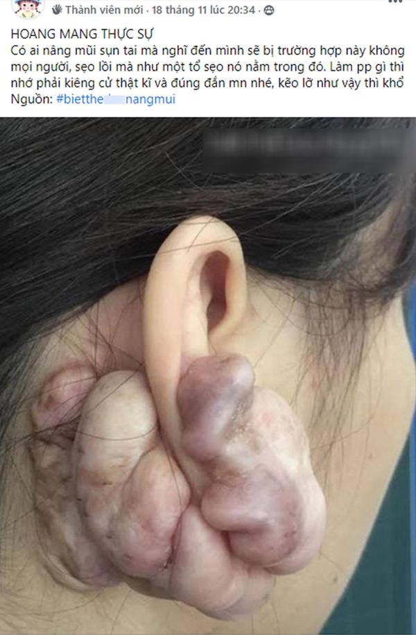 Hình ảnh sẹo đùn kín tai do nâng mũi bằng sụn tai gây sốc trên MXH và sự thật-1