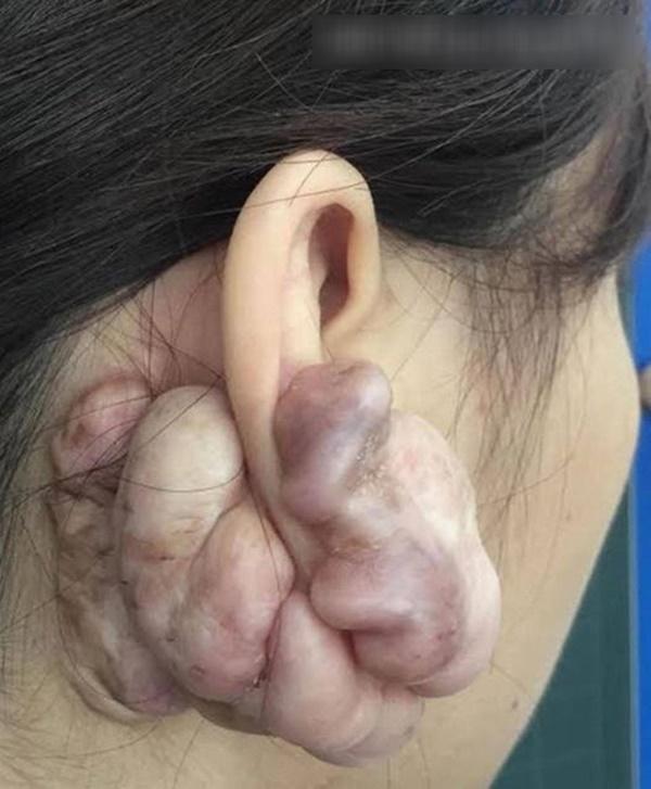 Hình ảnh sẹo đùn kín tai do nâng mũi bằng sụn tai gây sốc trên MXH và sự thật-2
