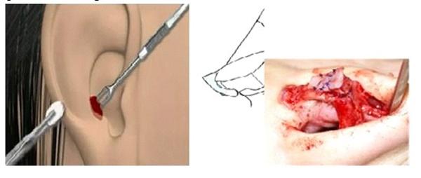 Hình ảnh sẹo đùn kín tai do nâng mũi bằng sụn tai gây sốc trên MXH và sự thật-3