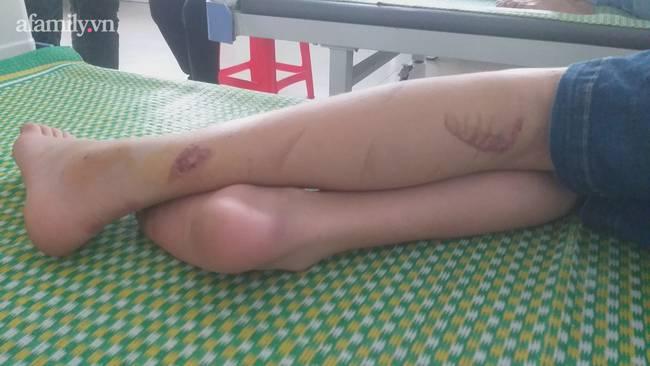 Nạn nhân 15 tuổi bị tra tấn kể nhiều lần ăn đòn bằng chày đập đá, cạo vảy cá ở lưng-3