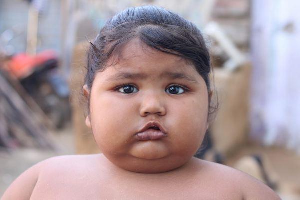 Cuộc sống bất thường của bé gái nặng nhất Ấn Độ-5
