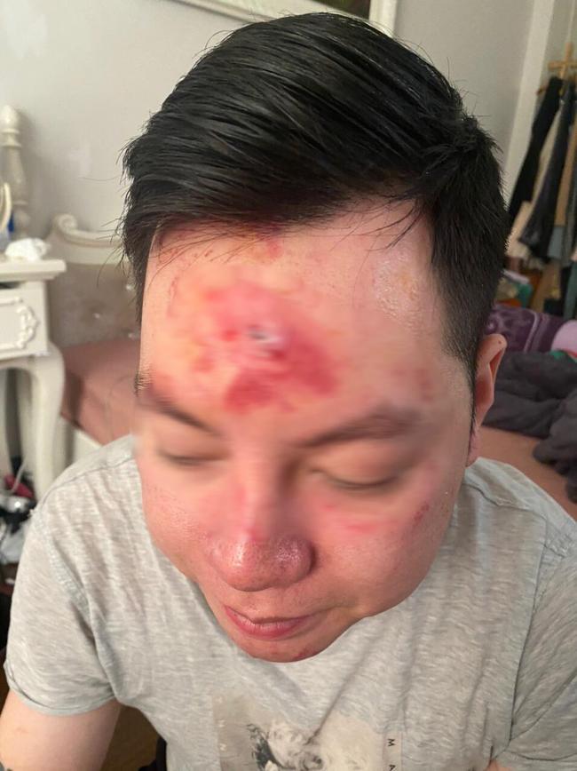 Hà Nội: Cãi vã vì mời rượu mà khách không uống, nhân viên quán bar xông vào đánh khách rách trán-2