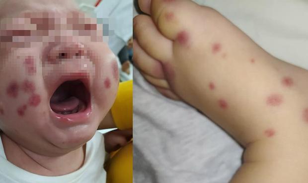 Bé trai xuất hiện mảng xuất huyết ở mặt, không ngờ là căn bệnh chưa từng ghi nhận ở Việt Nam-1