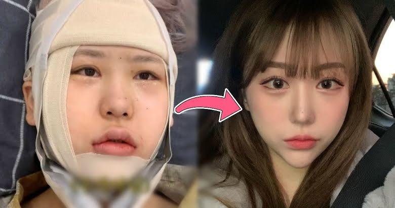 Youtuber Hàn lột xác như hot girl sau nhiều lần phẫu thuật thẩm mỹ-1