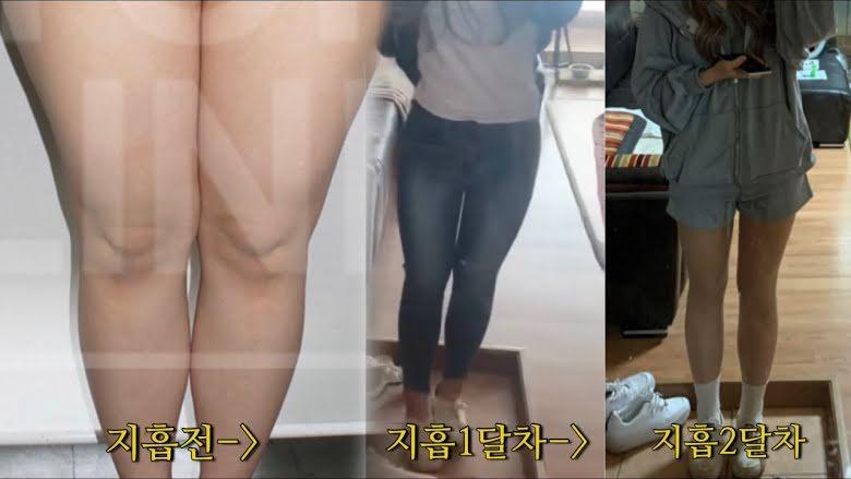 Youtuber Hàn lột xác như hot girl sau nhiều lần phẫu thuật thẩm mỹ-6