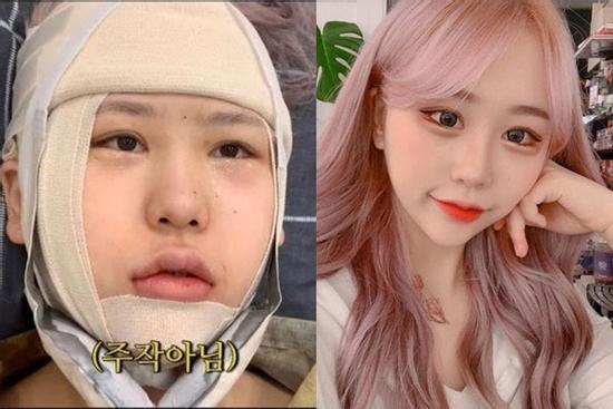 Youtuber Hàn 'lột xác' như hot girl sau nhiều lần phẫu thuật thẩm mỹ