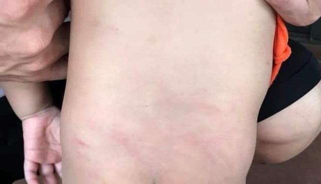 Bé mầm non bị giáo viên buộc vào ghế đánh, lưng và mông chằng chịt đòn roi-1