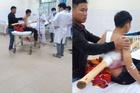 Kinh hoàng: Nam sinh bị khúc gỗ dài 2m đâm xuyên người sau va chạm với xe chở keo