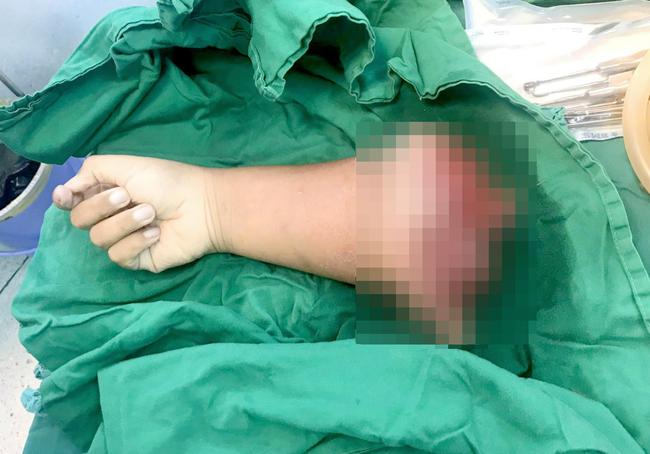 Kinh hoàng: Xế nhí 8 tuổi ở Long An chạy xe máy bị tai nạn đứt lìa cánh tay-1