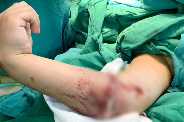 Kinh hoàng: Xế nhí 8 tuổi ở Long An chạy xe máy bị tai nạn đứt lìa cánh tay-2