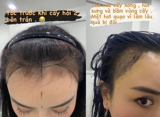 ‘Phạm Băng Băng phiên bản Việt’ chi cả trăm triệu đồng chữa hói-2