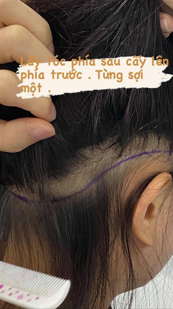 ‘Phạm Băng Băng phiên bản Việt’ chi cả trăm triệu đồng chữa hói-3