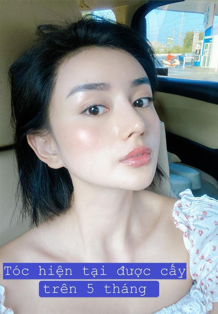 ‘Phạm Băng Băng phiên bản Việt’ chi cả trăm triệu đồng chữa hói-4