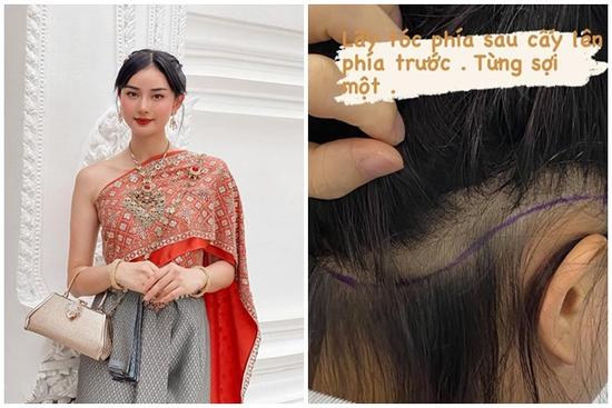 ‘Phạm Băng Băng phiên bản Việt’ chi cả trăm triệu đồng chữa hói