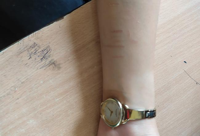 CẢNH BÁO: Nhiều học sinh dùng dao lam tự rạch cơ thể, coi đó là thú vui xả stress-4