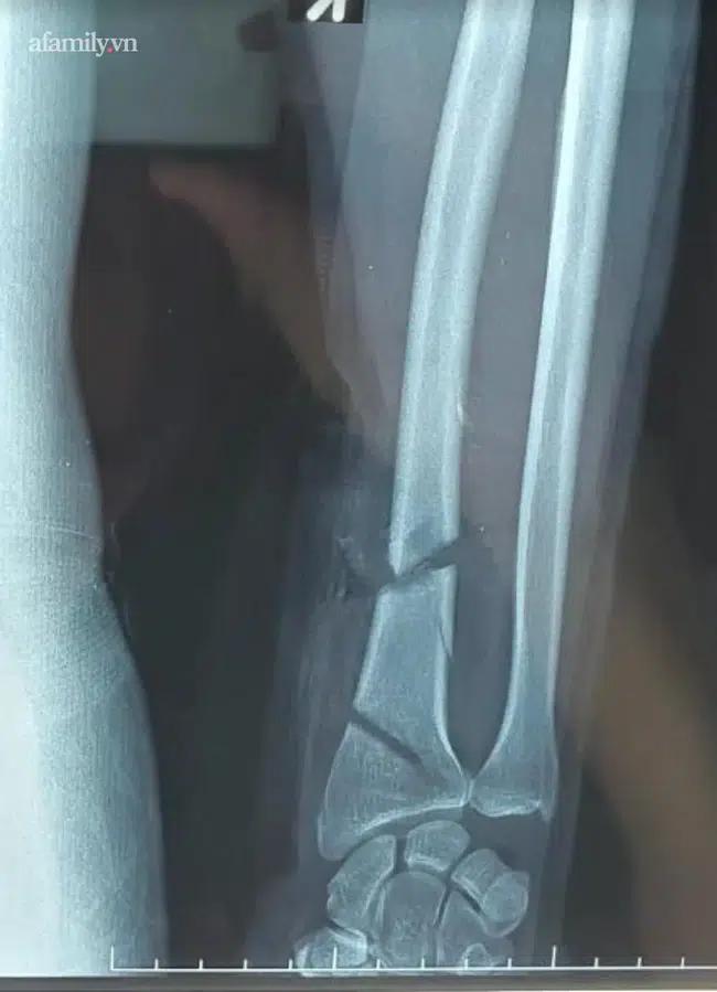 Dùng cưa máy tỉa cây, người đàn ông 62 tuổi bị cắt gần đứt lìa tay chân-2