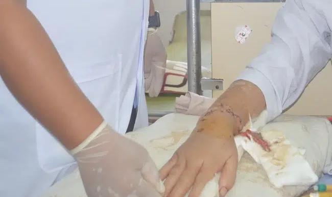 Dùng cưa máy tỉa cây, người đàn ông 62 tuổi bị cắt gần đứt lìa tay chân-3