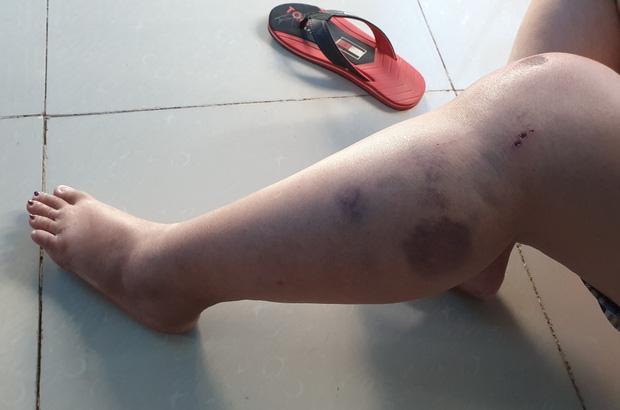 Côn đồ đánh nữ sinh khâu 10 mũi sau khi gây tai nạn: Nạn nhân thứ 3 bị dọa bắn-2