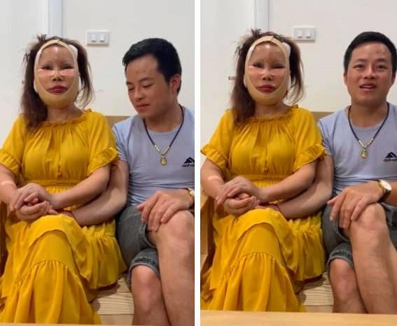 Gương mặt méo lệch của cô dâu 63 tuổi ở Cao Bằng sau nửa năm đại phẫu-1