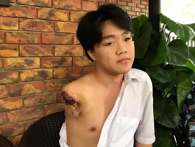Nam sinh 16 tuổi bị máy tiện cuốn đứt lìa tay phải trong giờ thực hành tại trường-1