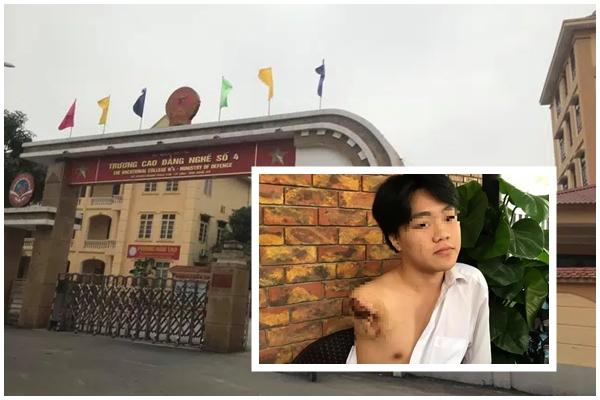 Bước ra từ quán cơm, thanh niên bị 2 người lạ chém gần đứt lìa cẳng tay-2