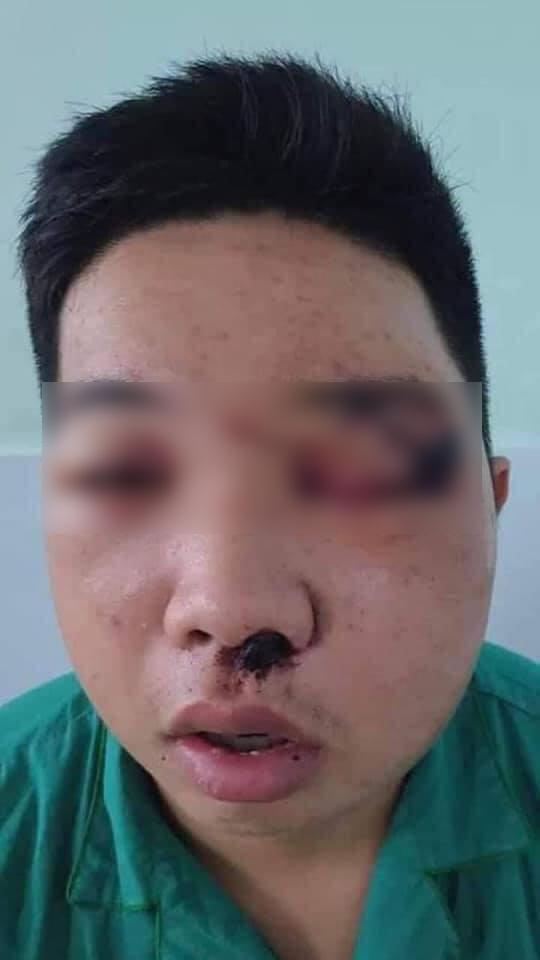Lan truyền ảnh thanh niên Tây Ninh phát ngôn sốc về nghệ sĩ Chí Tài bị đánh sưng mặt mũi-4