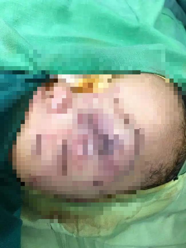 Bé trai 2 tuổi ở Nghệ An bị chó nhà nuôi cắn nát mặt, tổn thương nặng-1