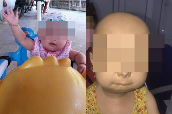 Hi hữu: Bé gái 6 tuổi hóa thành bà lão từ khi lên 2 vì mắc bệnh lạ