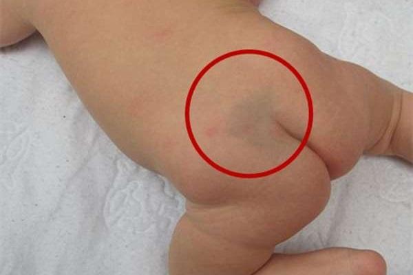 Những vết bớt bẩm sinh báo hiệu phúc khí của bạn-1