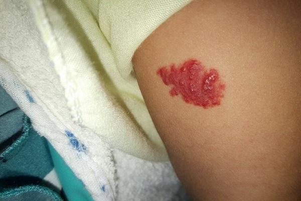 Những vết bớt bẩm sinh báo hiệu phúc khí của bạn-3