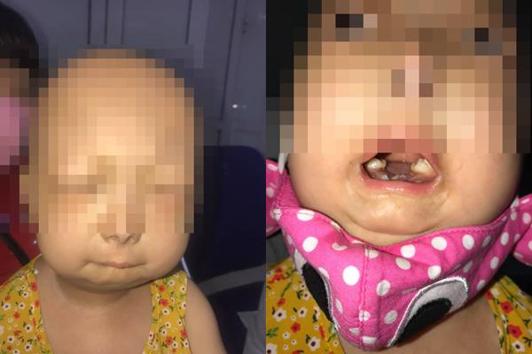 Bé gái Thái Bình 6 tuổi đã bị lão hoá như người già-1