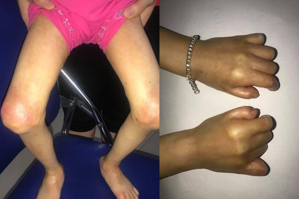 Bé gái Thái Bình 6 tuổi đã bị lão hoá như người già-2