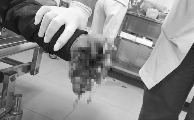 Hai anh em nghịch pháo nổ, người nát bàn tay, người nát mặt-2