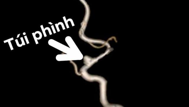 Bé trai 3 tuổi bất ngờ đột quỵ trong lúc đang vui chơi với bạn-1