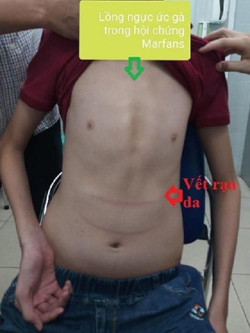 Cậu bé ở Thanh Hóa mắc bệnh lạ, cao tới 1m8 khi mới 11 tuổi-1