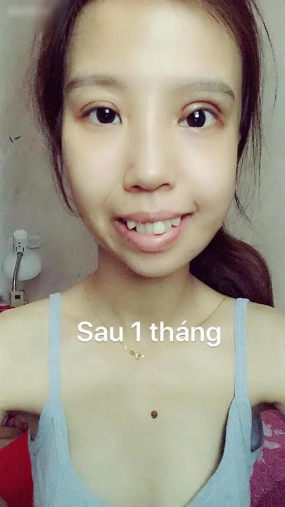 9X bị hội chứng kém phát triển một bên mặt lột xác như hot girl sau thẩm mỹ-3