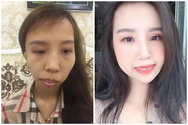 Xót xa gia cảnh hai anh em bị hội chứng người lùn đầu chim ở Thái Bình-4