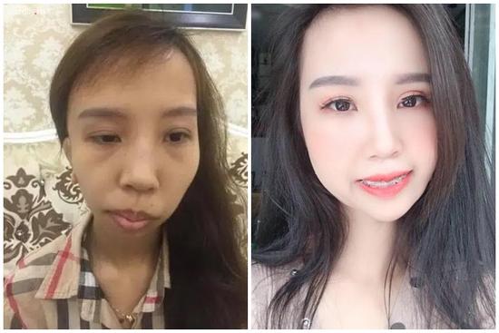 9X bị hội chứng kém phát triển một bên mặt 'lột xác' như hot girl sau thẩm mỹ