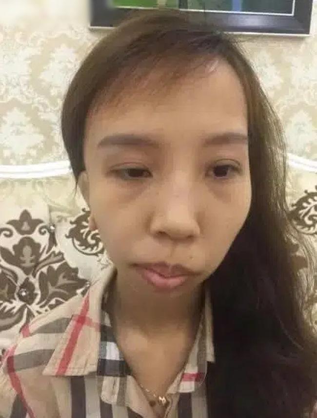 9X bị hội chứng kém phát triển một bên mặt lột xác như hot girl sau thẩm mỹ-1