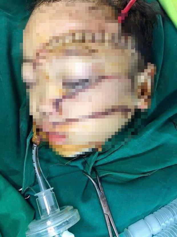 Bé trai 5 tuổi bị bố chém khâu hơn 300 mũi, bệnh viện cấp cứu mức báo động đỏ-1